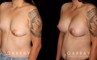 Before-and-after photos for patient with unilateral breast lift and bilateral breast augmentation. The improved symmetry restored a more natural look to the breasts with even nipple position.