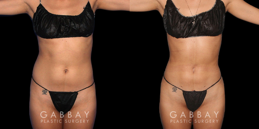 Procedures Depicted:  BBL, Lipo to Abdomen, Waist, and Tailbone, Fat Transfer to Butt. Before-and-after for patient with combined cosmetic surgeries, including BBL, abdominal lipo. Note the 360-degree slimming with enhanced buttocks roundness from the natural fat transfer.