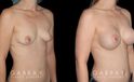 Silicone implants results for female patient in her 30s. Smaller, loose breasts were augmented to a firmer, taut volume with minimal overhang for improved comfort.
