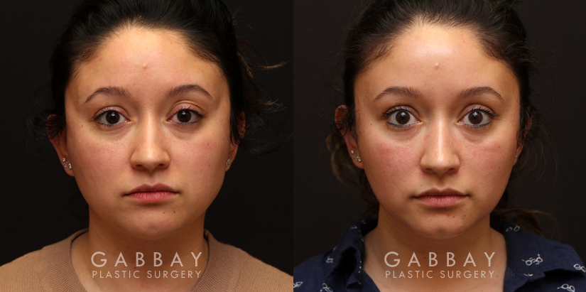 Procedures Depicted:  Buccal Fat Pad Removal