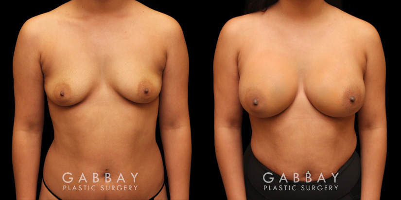 Photos for female patient before and after silicone implant procedure. Note the robust increase in breast size while continuing to match her body’s aesthetic for an aligned appearance.