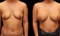 Photos for female patient before and after silicone implant procedure. Note the robust increase in breast size while continuing to match her body’s aesthetic for an aligned appearance.