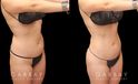 With precise liposuction for the sides, abdomen, and waist, this patient was able to restore her youthful figure and body shape, and achieved virtually no belly fat pockets bulging over the pants line.