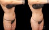 With precise liposuction for the sides, abdomen, and waist, this patient was able to restore her youthful figure and body shape, and achieved virtually no belly fat pockets bulging over the pants line.