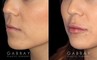 Patient 08 3/4th Left Side View Lip Augmentation Gabbay Plastic Surgery
