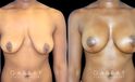 Silicone breast augmentation before-and-after photos demonstration enhanced breast size. Patient combined augmentation with a breast lift for improved breast position as well.