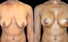 Silicone breast augmentation before-and-after photos demonstration enhanced breast size. Patient combined augmentation with a breast lift for improved breast position as well.