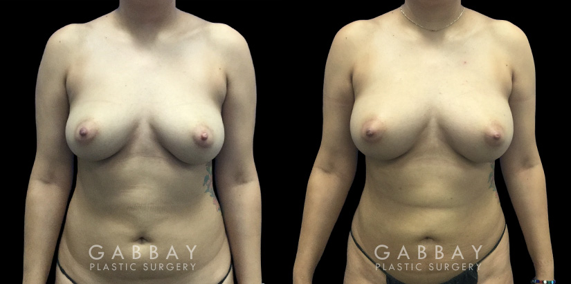 Patient 08 Front View Breast Fat Grafting Gabbay Plastic Surgery