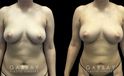 Patient 08 Front View Breast Fat Grafting Gabbay Plastic Surgery