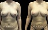 Patient 08 Front View Breast Fat Grafting Gabbay Plastic Surgery