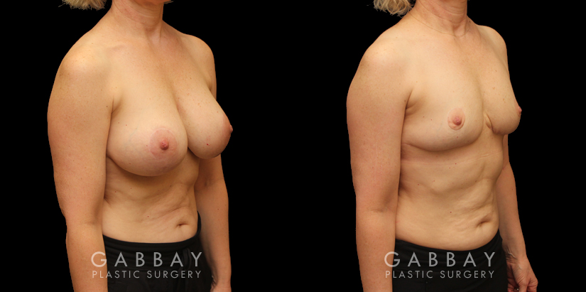 Procedures Depicted:  Auto Augmentation with mesh