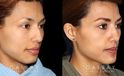 Patient 01 3/4th Right Side View Rhinoplasty Gabbay Plastic Surgery