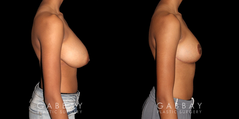 Procedures Depicted:  Breast Reduction