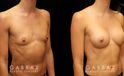 This is an extremely athletic woman who wanted a softer look for her torso. She had silicone breast augmentation using Allergan Natrelle soft touch moderate profile implants placed through a lower breast/inframammary incision and under her muscle in a dual plane position.. Her implants were 255 cc.