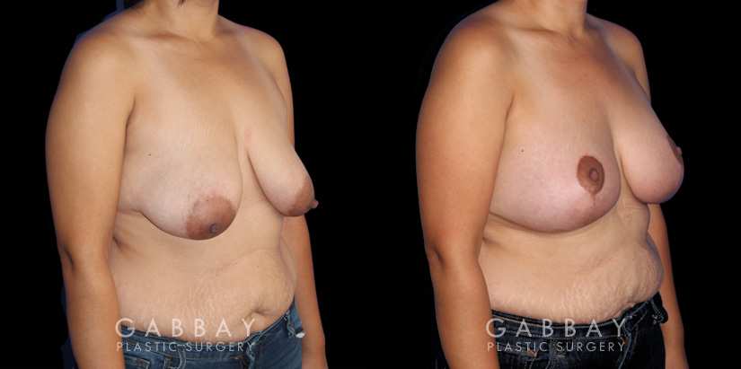 Procedures Depicted:  Breast Augmentation – Silicone, Mastopexy