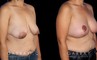 Procedures Depicted:  Breast Augmentation – Silicone, Mastopexy