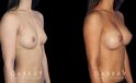 Before-and-after photos for breast augmentation showing fully recovered patient. Note the lack of visible scarring despite the dramatic increase to bust volume. Balanced, round breast shape enhances the patient’s natural figure.