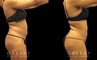 Younger female patient showcasing her results after belly fat removal via liposuction surgery. Note the reduction of ‘love handles’ and a flatter stomach for a defined lower torso aesthetic.