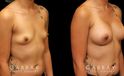 Silicone implants were used to increase breast roundness and volume. Note how the breasts kept their position while filling out for a balanced appearance.