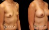 Silicone implants were used to increase breast roundness and volume. Note how the breasts kept their position while filling out for a balanced appearance.