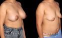 Procedures Depicted:  Breast Augmentation – Silicone & Lift