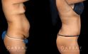 Before and after tummy tuck combined with hernia repair. By removing fat, tightening loose skin, and repairing the abdominal wall, Dr. Gabbay restored a slimmer, healthy appearance to the stomach area and tissues.
