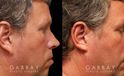 Patient 01 Right Side View Ear reduction Gabbay Plastic Surgery