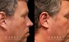 Patient 01 Right Side View Ear reduction Gabbay Plastic Surgery