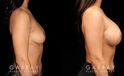 This is a breast augmentation patient who had significant asymmetry. She underwent silicone breast implant augmentation, using different sized high profile Allergan Natrelle Soft Touch implants: 365 cc on the left, 435 cc on the right. Implants were placed below the muscle in a dual plane configuration using an incision that is beautifully hidden within the breast fold.