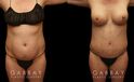 Patient before and after tummy tuck combined with breast augmentation and breast lift. By increasing breast volume, heightening breast position, and tightening the abdominal area, the patient has a slimmer, yet feminine figure.