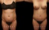 Patient before and after tummy tuck combined with breast augmentation and breast lift. By increasing breast volume, heightening breast position, and tightening the abdominal area, the patient has a slimmer, yet feminine figure.