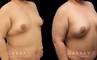 Patient 19 Front View Breast Fat Grafting Gabbay Plastic Surgery