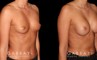 Patient results for breast augmentation. Note the rounded shape and lack of visible scarring. Patient’s recovery was smooth, absent of complications.