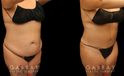 Tummy tuck before and after photos, along with combined liposuction, breast lift, and breast augmentation. Abdominal tightening enhanced the increase in breast volume for a curvier, fitter aesthetic.