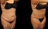 Tummy tuck before and after photos, along with combined liposuction, breast lift, and breast augmentation. Abdominal tightening enhanced the increase in breast volume for a curvier, fitter aesthetic.
