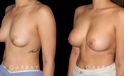 Female patient in her 20s before-and-after revision breast augmentation, including implant removal and replacement with additional breast lift to improve breast position.
