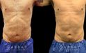 Male liposuction before-and-after photo for 360 lipo showing a result in a slimmer waist and flatter abdominal area for an enhanced torso contour. Flanks are significantly slimmed and present a toned silhouette.