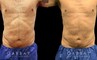 Male liposuction before-and-after photo for 360 lipo showing a result in a slimmer waist and flatter abdominal area for an enhanced torso contour. Flanks are significantly slimmed and present a toned silhouette.