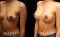 Breast augmentation for younger female patient. Note the pleasing roundness to the breasts that matches her natural body shape well for an attractive enhancement.