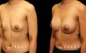 Before and after silicone implants for female patient. Her breast augmentation went smoothly and the recovery was without complications.