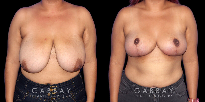 Procedures Depicted:  Mastopexy