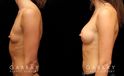 This is an extremely athletic woman who wanted a softer look for her torso. She had silicone breast augmentation using Allergan Natrelle soft touch moderate profile implants placed through a lower breast/inframammary incision and under her muscle in a dual plane position.. Her implants were 255 cc.