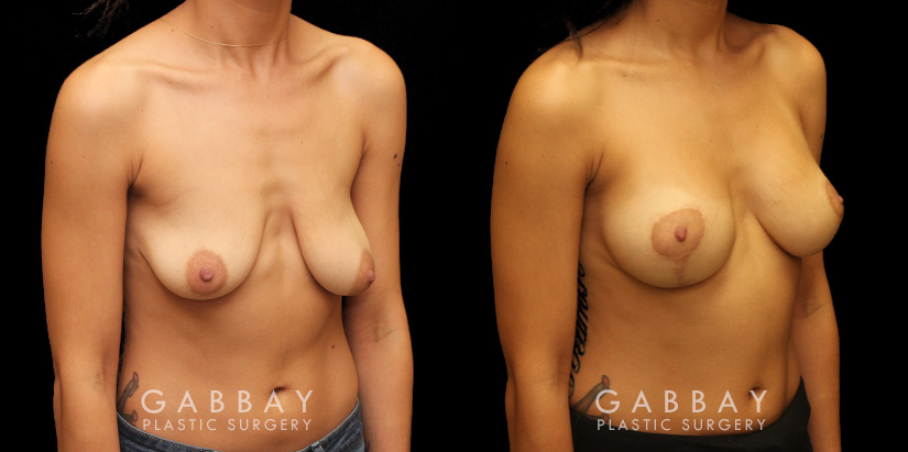 Breast lift combined with breast augmentation using silicone implants. Before-and-after photos demonstrate dramatic aesthetic enhancement of the breasts regarding shape, size, and position. Breast drooping was completely addressed and symmetry was enhanced.