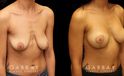 Breast lift combined with breast augmentation using silicone implants. Before-and-after photos demonstrate dramatic aesthetic enhancement of the breasts regarding shape, size, and position. Breast drooping was completely addressed and symmetry was enhanced.