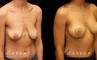 Breast lift combined with breast augmentation using silicone implants. Before-and-after photos demonstrate dramatic aesthetic enhancement of the breasts regarding shape, size, and position. Breast drooping was completely addressed and symmetry was enhanced.