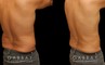 Late 30s male patient before and after male liposuction. Targeted fat removal resulted in a flatter abdomen and significant reduction of flank volume. Note the reduction of waist curves for a straighter silhouette.