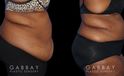 Patient photos showing before and after abdominoplasty procedure. Before surgery, the patient had significant banding and loose skin over the abdomen. Following liposuction to multiple areas combined with surgical excision of excess skin, the final result is a tighter, firmer look.