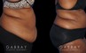 Patient photos showing before and after abdominoplasty procedure. Before surgery, the patient had significant banding and loose skin over the abdomen. Following liposuction to multiple areas combined with surgical excision of excess skin, the final result is a tighter, firmer look.