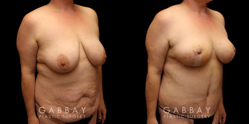 Procedures Depicted:  Tummy Tuck and Breast lift