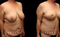Procedures Depicted:  Tummy Tuck and Breast lift